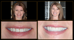 anterior veneers before and after