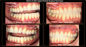 pinhole surgical technique