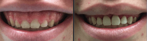 Clinical crown lengthening at Duncan Dental Studio